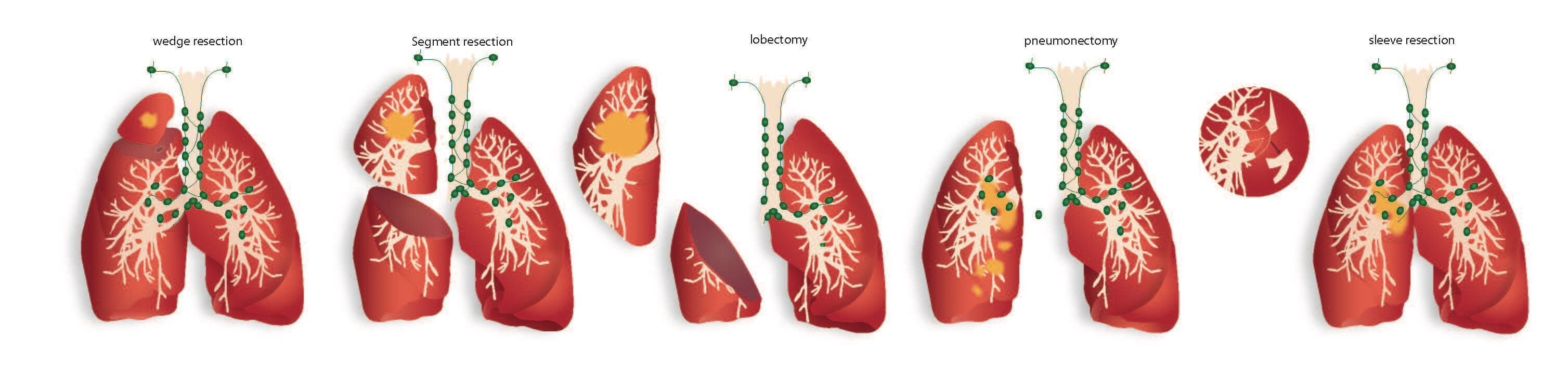 Lung Resection methods Companies I have worked for
